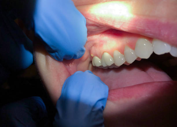 Best Dental Abscess Treatment in Baldwin Park, CA